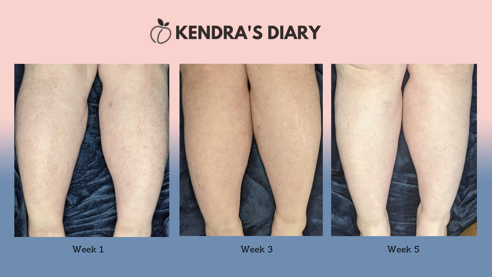 41+ laser hair removal before and after legs DanahAoifee