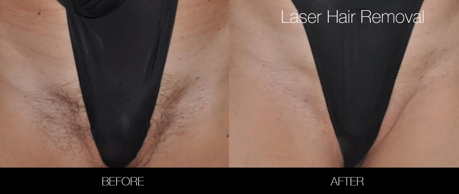 How Much Does Brazilian Laser Hair Removal Cost?